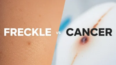 freckle or cancer
